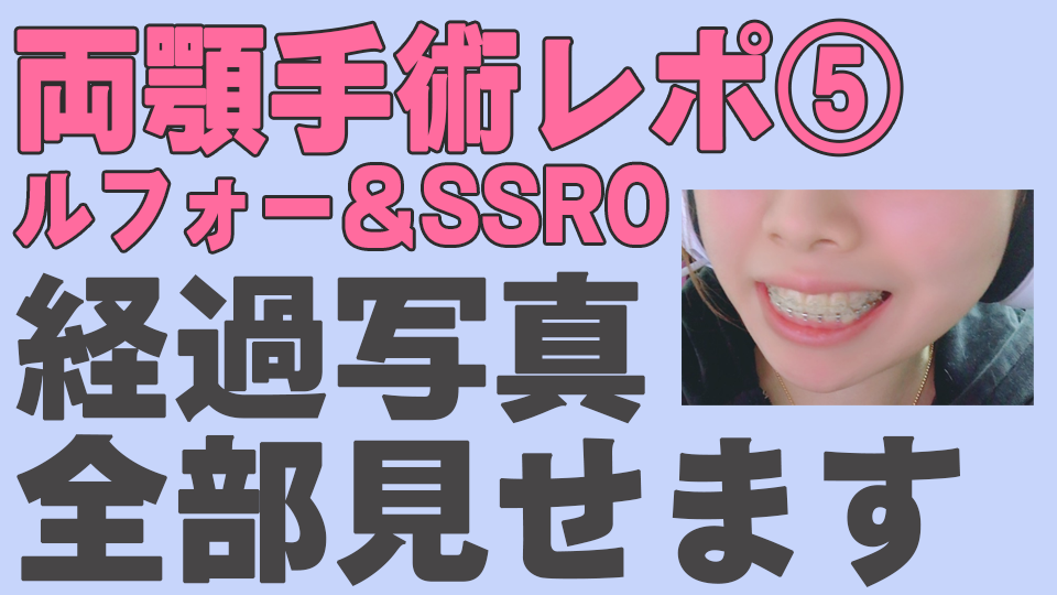 両顎手術(ルフォー&SSRO)レポート⑤ ダウンタイムから完成まで正面・横顔全写真を公開!メリット・デメリットまとめ - 可愛い目指して三千里