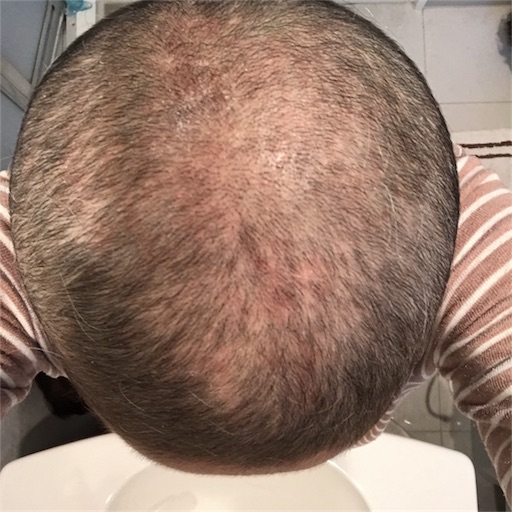 脱毛事情 発毛事情 なんとかなる