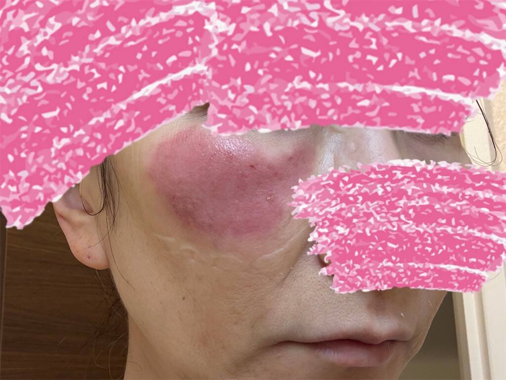 レーザー治療後