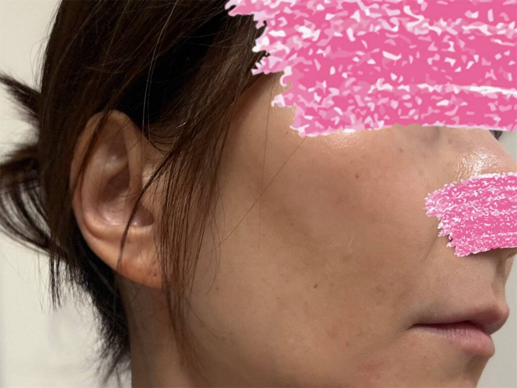 レーザー治療前