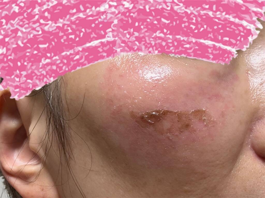 レーザー治療１０日目