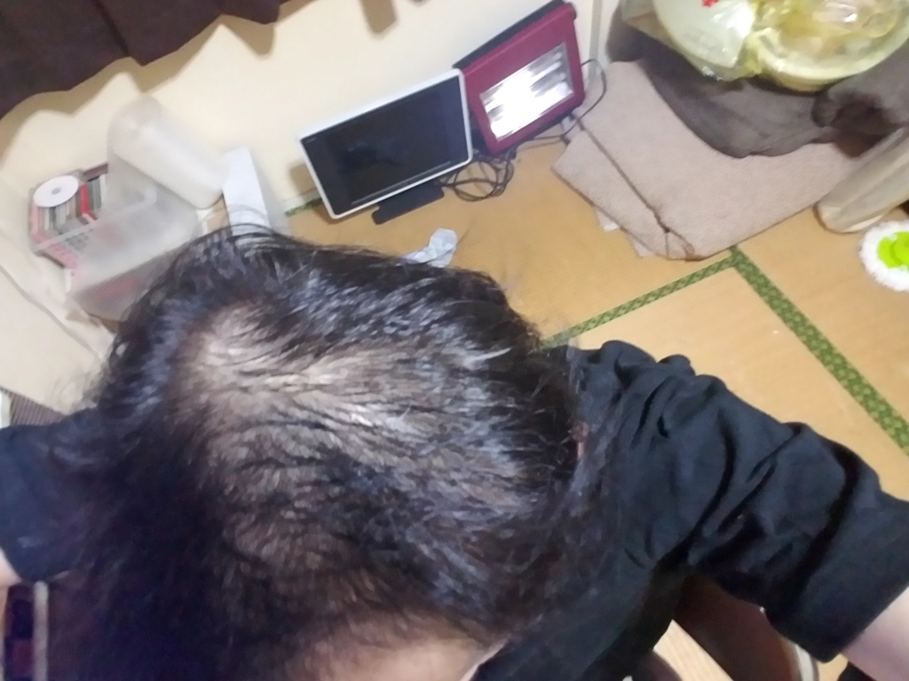 炭酸水シャンプーを実践してみた 40代男の育毛日記