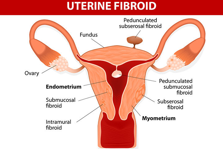 f:id:uterinefibroids:20170810135841j:plain