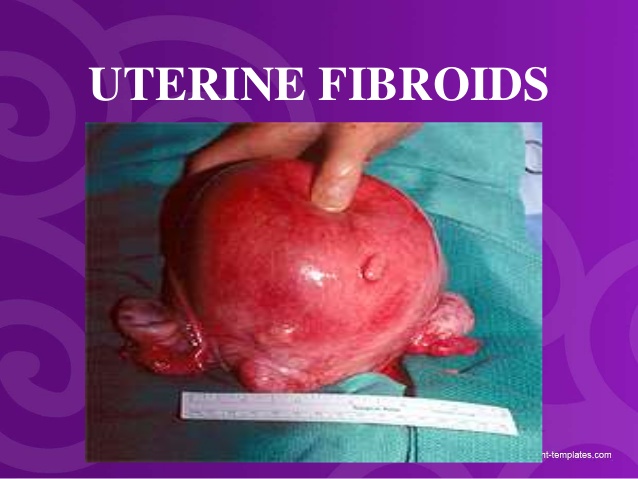 f:id:uterinefibroids:20170810142303j:plain