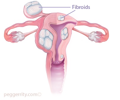 f:id:uterinefibroids:20170810144626j:plain