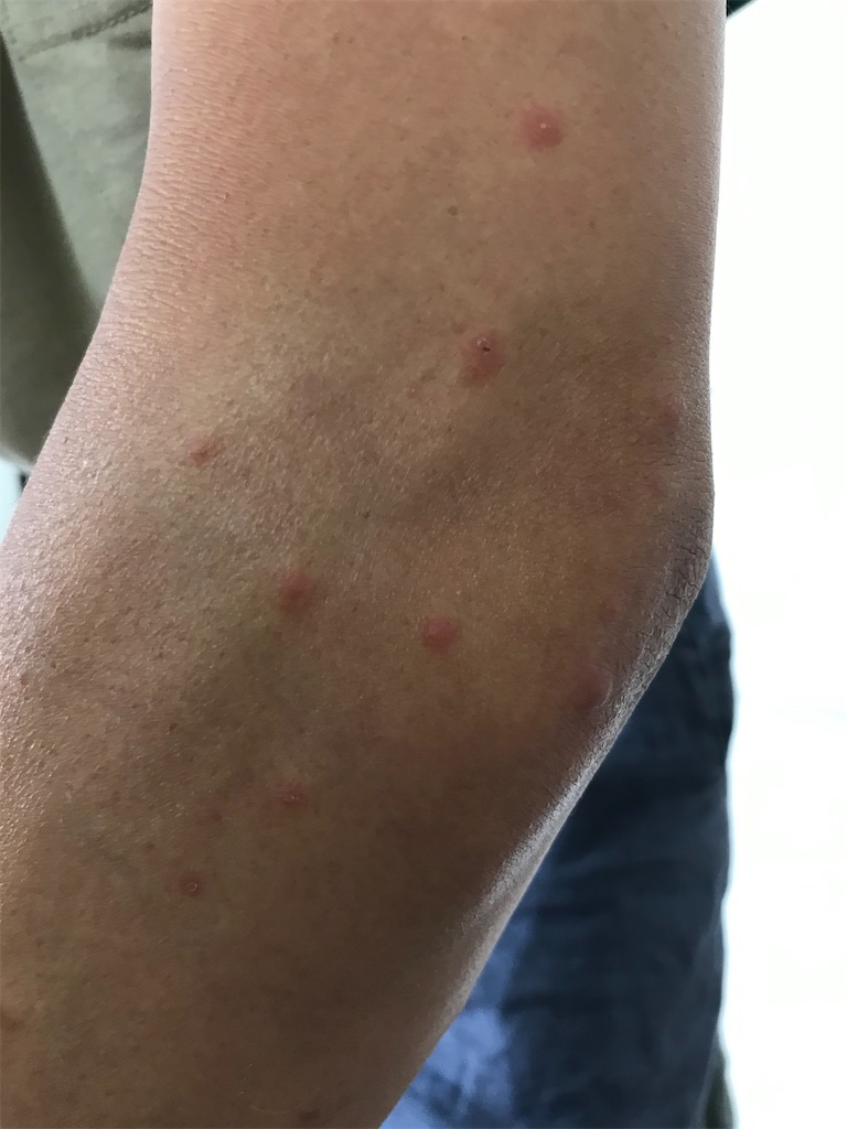 ヌカカにやられた 虫刺され その後 自称大器晩成お父さん45歳からの3兄妹子育て検証ブログ ヌカカにやられた 虫刺され その後 自称大器晩成お父さん45歳からの3兄妹子育て検証ブログ