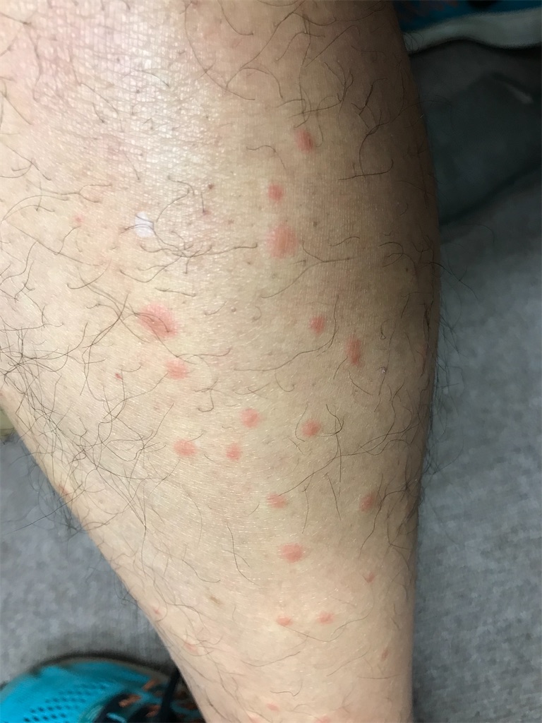 ヌカカにやられた 虫刺され その後 自称大器晩成お父さん45歳からの3兄妹子育て検証ブログ ヌカカにやられた 虫刺され その後 自称大器晩成お父さん45歳からの3兄妹子育て検証ブログ