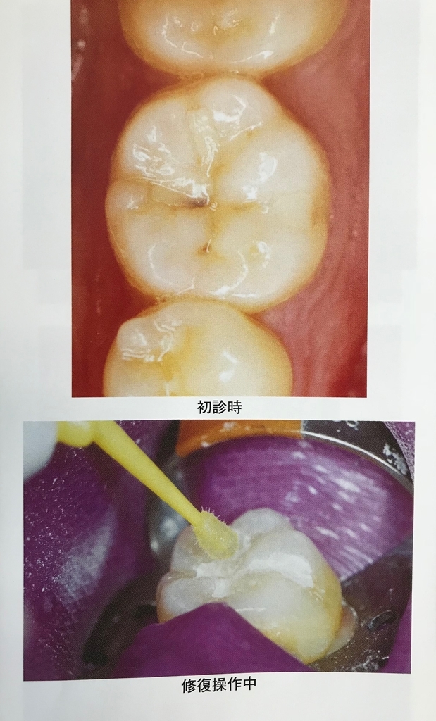 グラスアイオノマーセメントのツボ 歯科材料のツボ