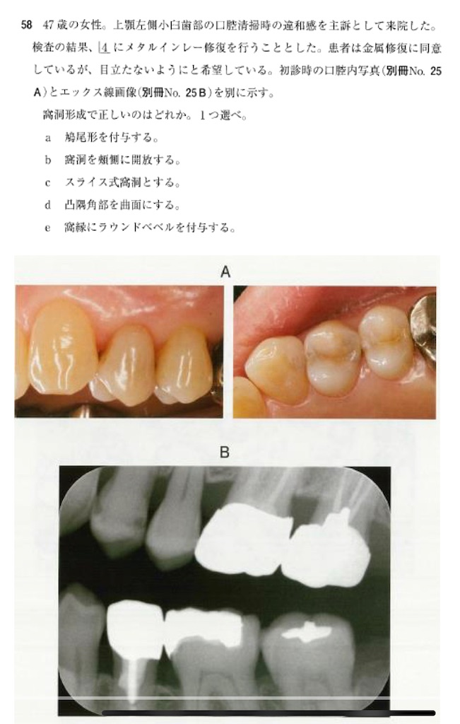 歯科再生・修復医療と材料 115回歯科医師国家試験【115B-58】保存修復学 窩洞外形編