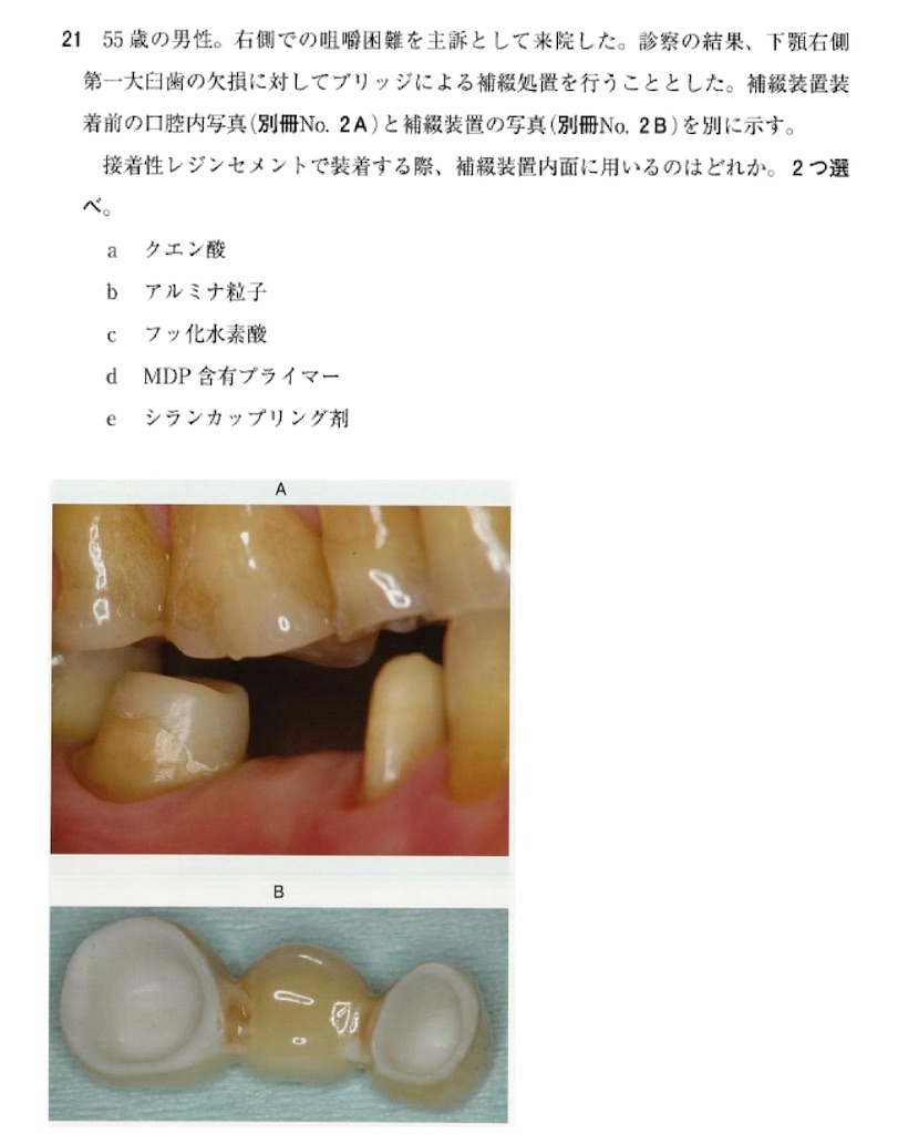 115回歯科医師国家試験【115B-21】歯間補綴学 ジルコニアブリッジ編