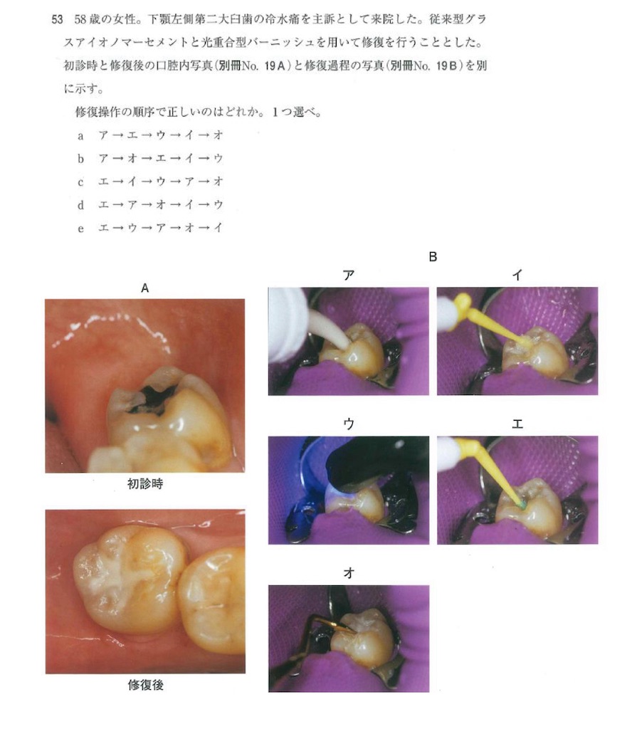 117回歯科医師国家試験【117A-53】保存修復学：グラスアイオノマー修復