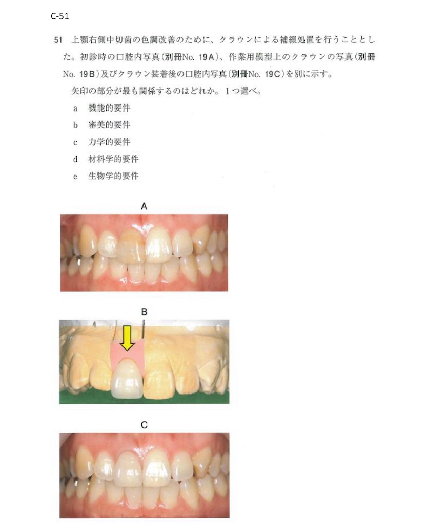 117回歯科医師国家試験【117C-51】歯冠補綴学：個歯トレー