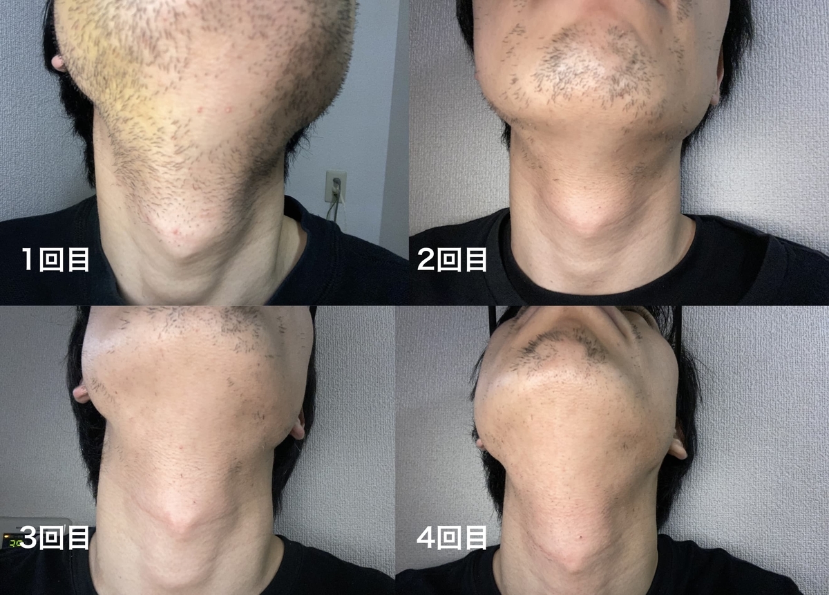 ヒゲ脱毛でツルツルにするには照射15回必要 照射後のヒゲ変化比較 定期更新 仮想サーファーの日常 ヒゲ脱毛でツルツルにするには照射15回必要 照射後のヒゲ変化比較 定期更新 仮想サーファーの日常