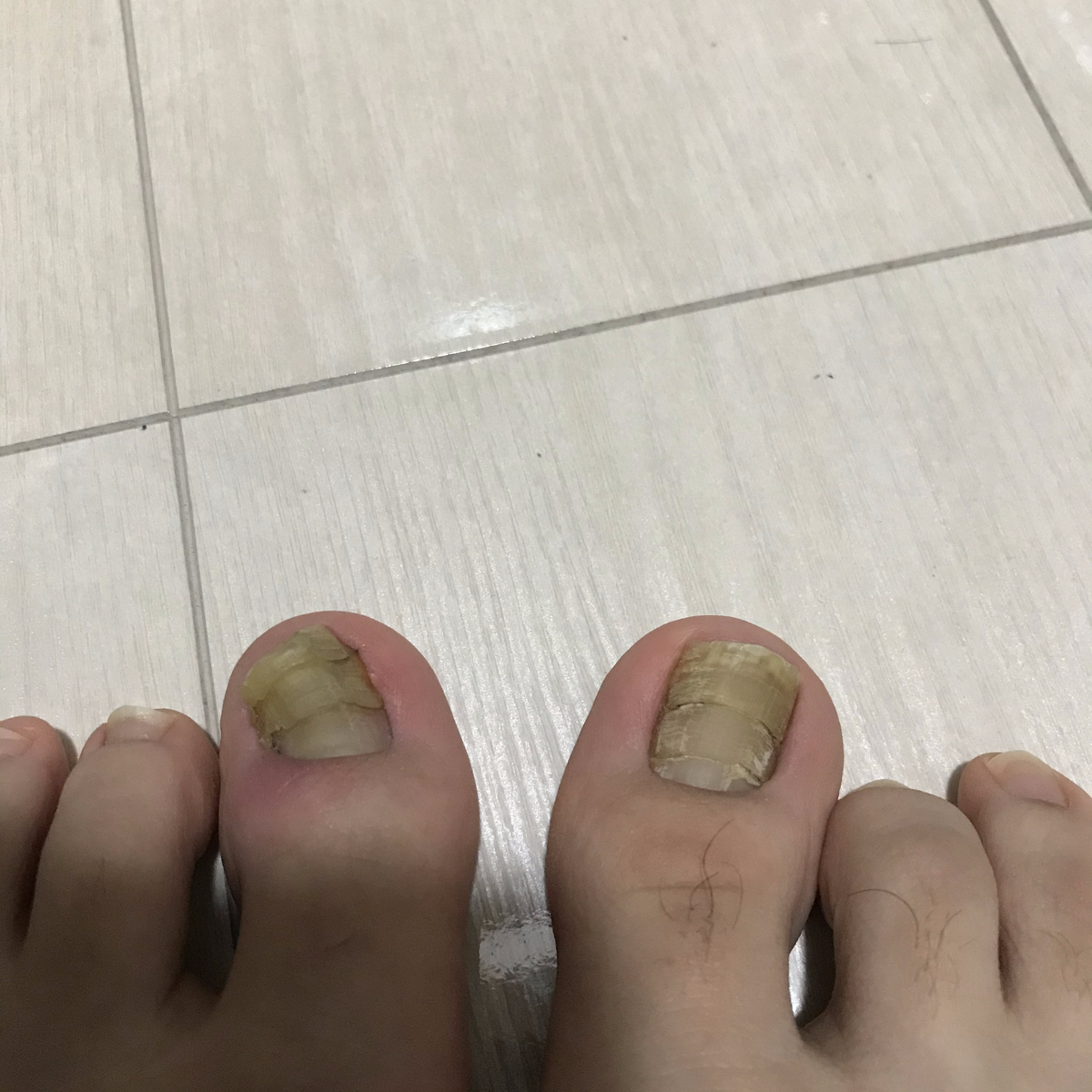 爪水虫の疑い 足の親指の異常を診てもらいに病院に行ってきた 閲覧注意 なおすけの日常