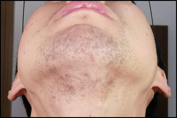 アゴしたのヒゲ