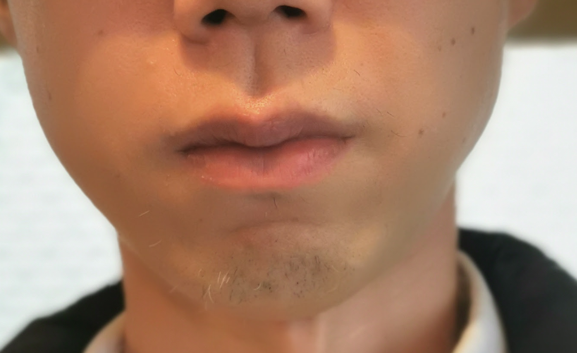 １０回目ヤグレーザー