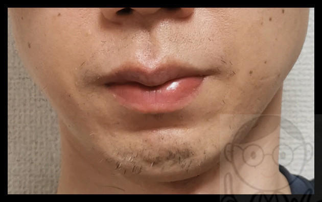 【動画】ゴリラクリニックヤグレーザーの効果【１０回目から２ヶ月経過】