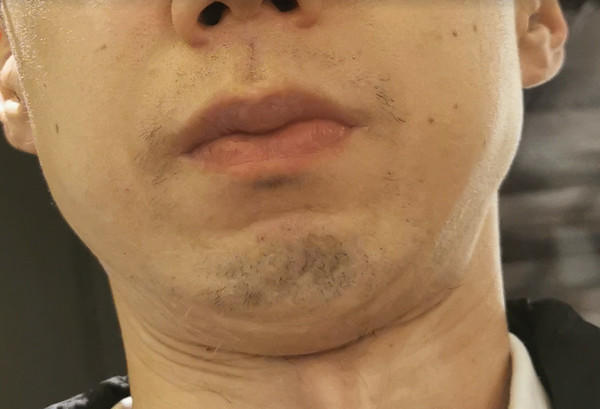 １０回目ヤグレーザーから２ヶ月経過