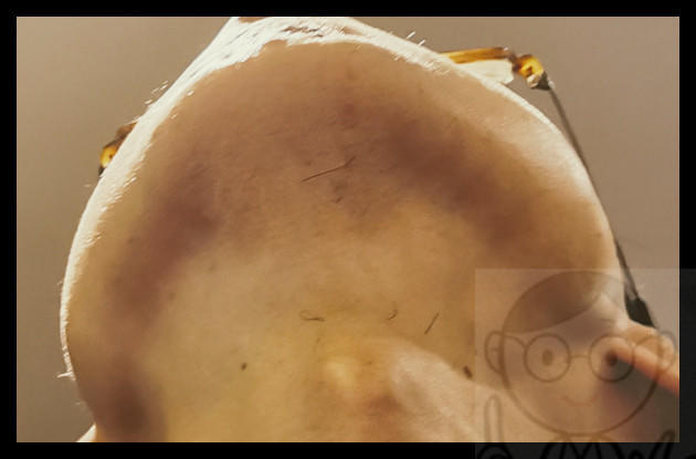 １０回目ヤグレーザーから２ヶ月経過