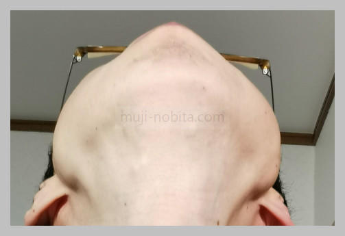 １１回目から１ヶ月経過の鼻下とアゴ