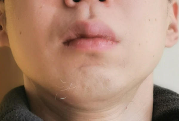 ヤグレーザーから１ヶ月後