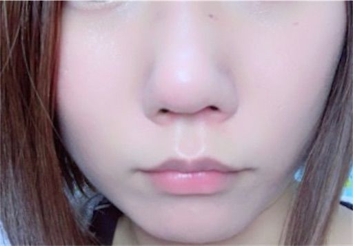 鼻プチで無理矢理鼻を高くした結果ｗｗｗｗ 悪あがけ ブス
