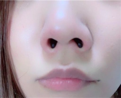 鼻プチで無理矢理鼻を高くした結果ｗｗｗｗ 悪あがけ ブス