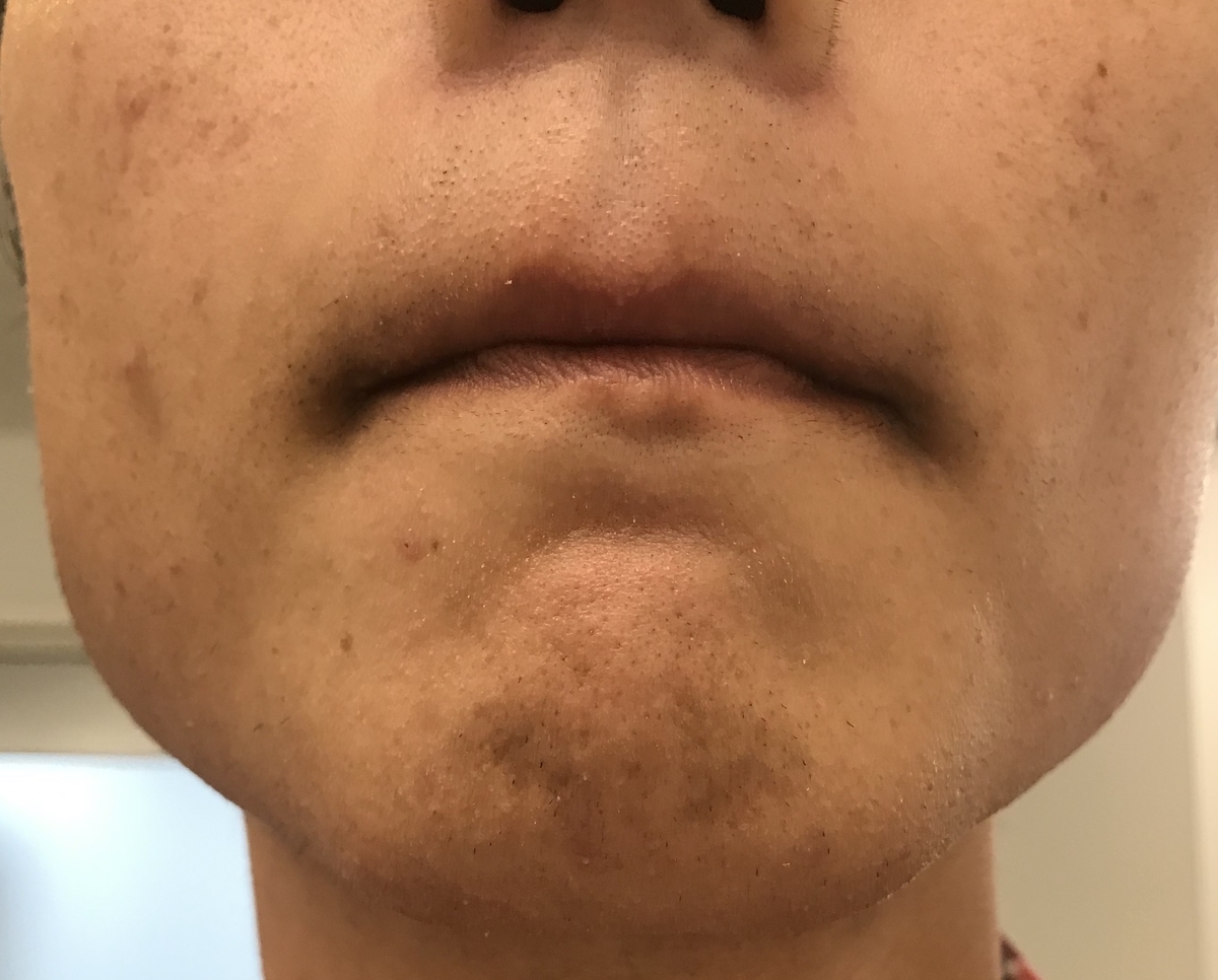 f:id:wkldpiqbl:20190909202938j:plain ヒゲ脱毛8回目1日経過1鼻下・アゴ