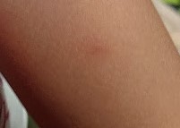 水いぼにはイソジンさまさま 働くくろぺんぎんの日記
