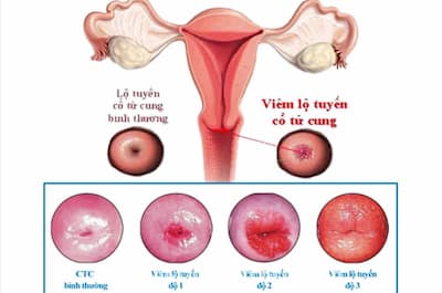 viêm lộ tuyến cổ tử cung