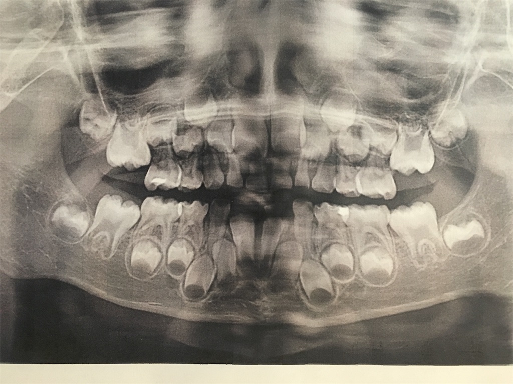 ５歳児のお口の中 レントゲンを撮ってもらった話 ゆるくまとめちゃいました