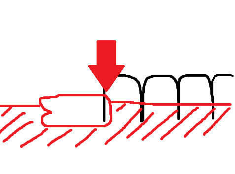 親知らずが真横に生えているため、隣の歯が危ないことに
