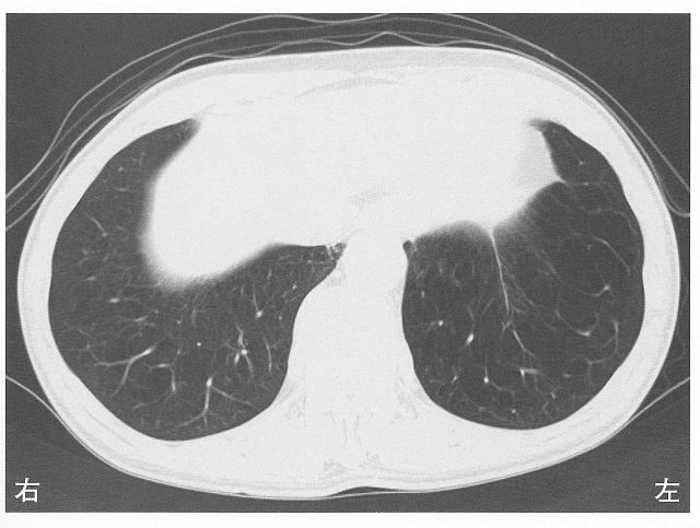 51回PT 午前問題17 80歳の男性。胸部CTを下に示す。 この患者で予想されるのはどれか。 ズバリ解説！理学