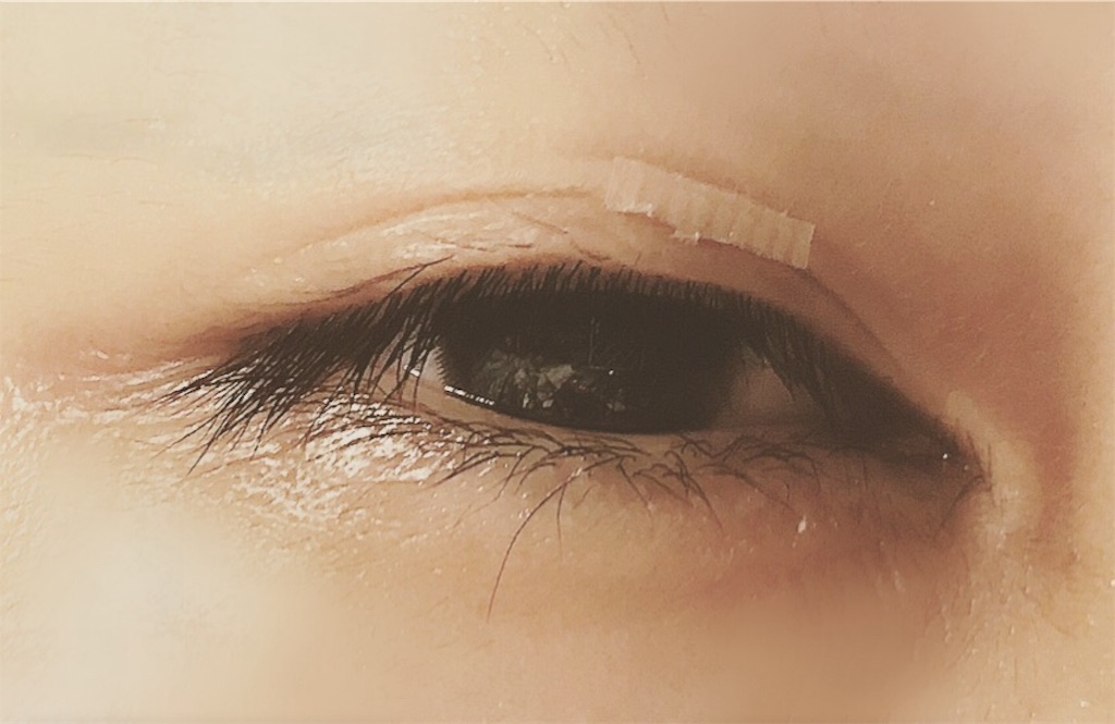 二重幅が狭い人必見 絆創膏で簡単に二重幅を広げる方法 闇鍋高校