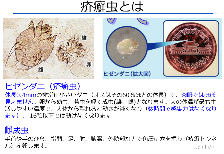 【皮ふの疾患について】見逃せない疥癬の診断とその知識(医療従事者むけ) - Yanase Derma’s Diary