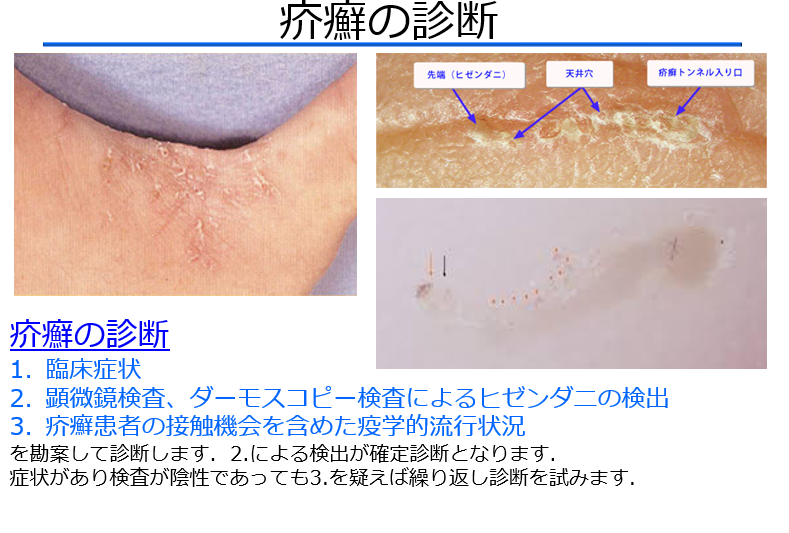 【皮ふの疾患について】見逃せない疥癬の診断とその知識(医療従事者むけ) - Yanase Derma’s Diary