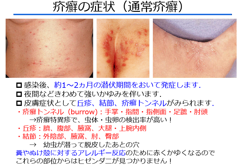 皮膚疥癬診断基準 | 乾癬性関節炎 画像診断まとめ _ 疥癬診療ガイドライン(第3版) – EHBO