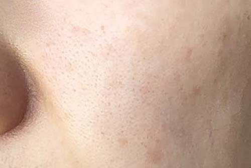 よかせっけんの毛穴の写真