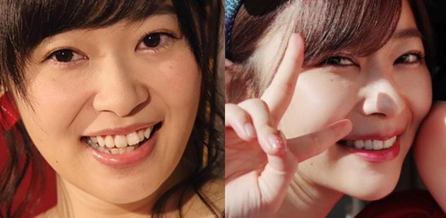指原莉乃さんは歯の矯正で口ゴボ改善 口元が変わってよりキレイに 大人矯正ろぐ 指原莉乃さんは歯の矯正で口ゴボ改善 口元が変わってよりキレイに 大人矯正ろぐ