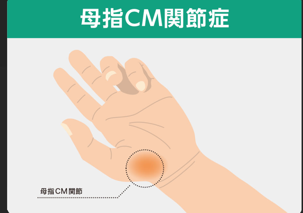 手の親指の付け根が痛む人必見! - ゆあさ鍼灸接骨院 日々あれこれ