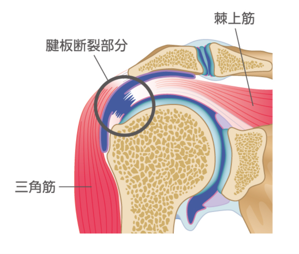 腱板断裂はどれぐらいの割合で起こる? - ゆあさ鍼灸接骨院 日々あれこれ