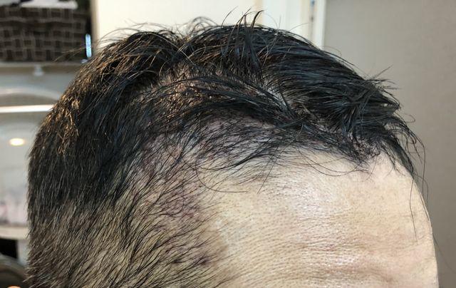 M字はげの植毛