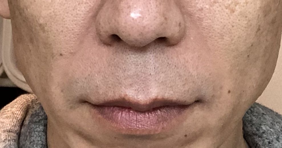 ほうれい線が消えた3ヶ月経過