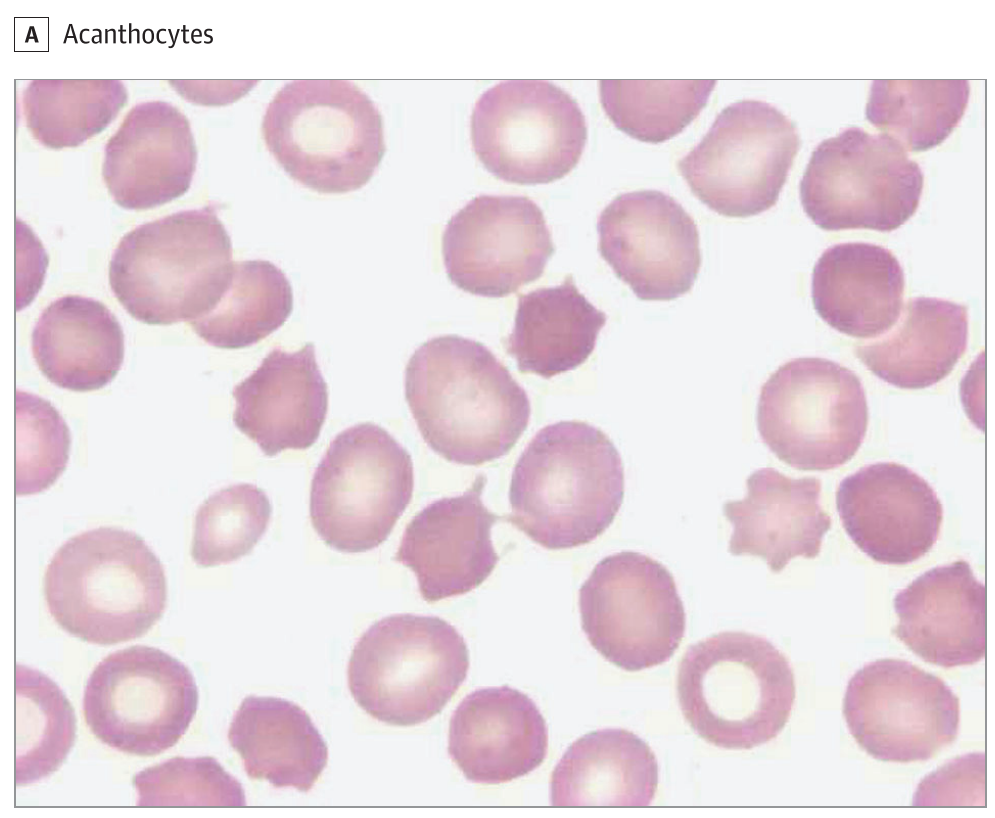 脳神経内科 文献備忘録－その25 口顔面ジスキネジアを呈した若年男性(JAMA Neurology Clinical Challengeより