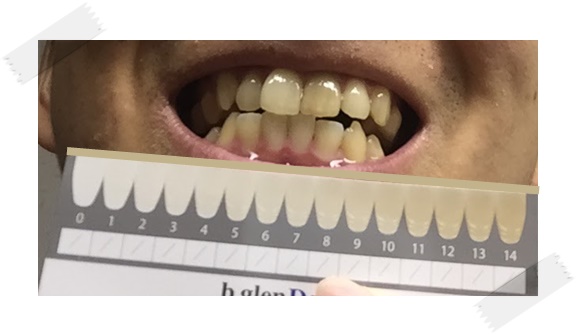 ちゅらトゥースホワイトニング3日目 ちゅらトゥースホワイトニング3日目