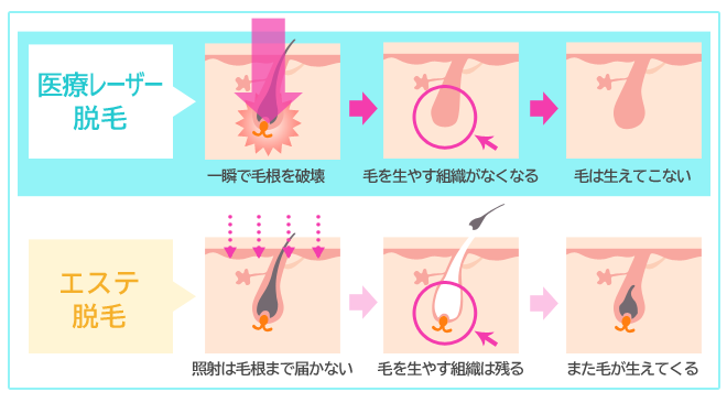 永久脱毛とエステ（一時）脱毛の違い