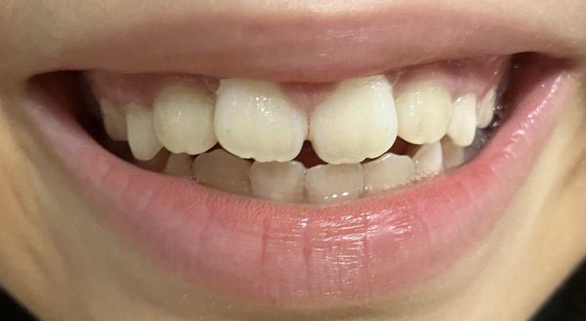 A SMILE（エースマイル）使用開始時（8歳3ヶ月）の歯並び・イーの口