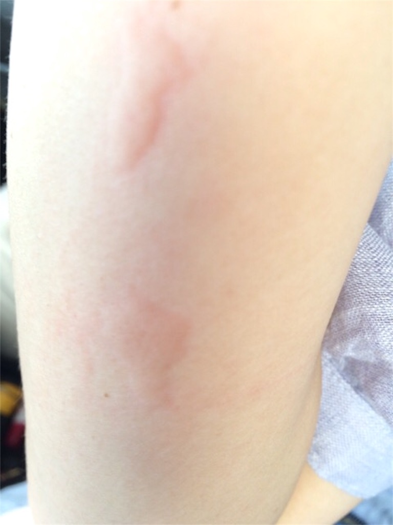 かゆい 蚊に刺されて痒いときは をすると一気にかゆみがひきます ゆるりーん かゆい 蚊に刺されて痒いときは をすると一気にかゆみがひきます ゆるりーん