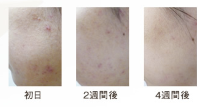 【女装 ニキビ】女装したいんだけれどニキビってどうすれば良いの？おすすめなスキンケアグッズを紹介！！ - Long tall base