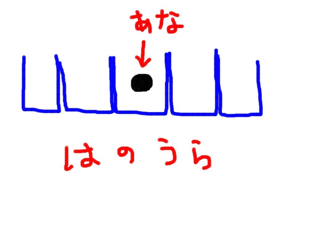 根の治療中